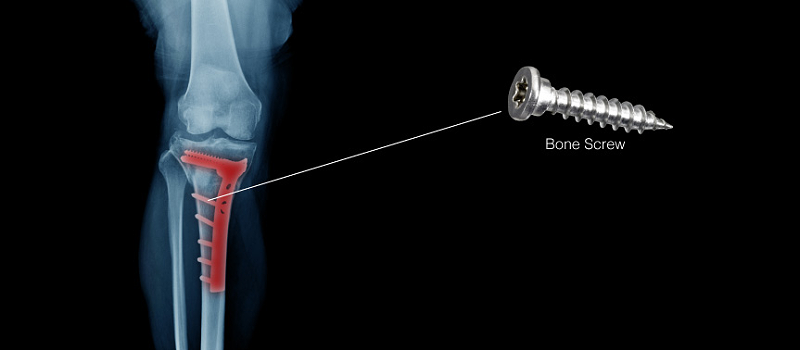 醫(yī)療骨釘加工<a href='/gaosuzhuzhou.htm' class='keys' title='點擊查看關(guān)于高速主軸的相關(guān)信息' target='_blank'>高速主軸</a>.png 醫(yī)療骨釘加工<a href='/gaosuzhuzhou.htm' class='keys' title='點擊查看關(guān)于高速主軸的相關(guān)信息' target='_blank'>高速主軸</a>.png